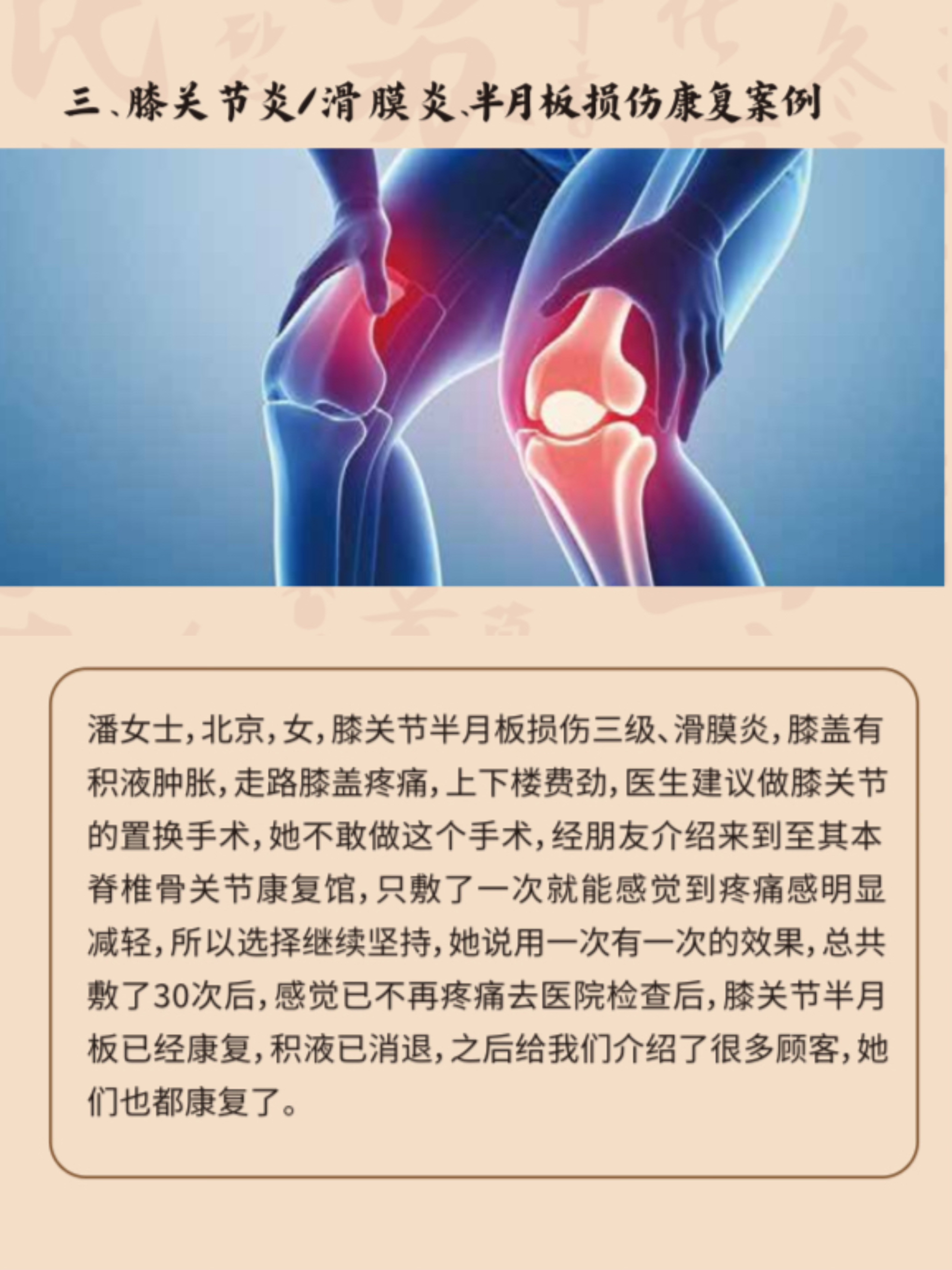 膝关节炎康复案例展示，患者接受中药热敷治疗过程，医护人员专业指导，体现治疗效果